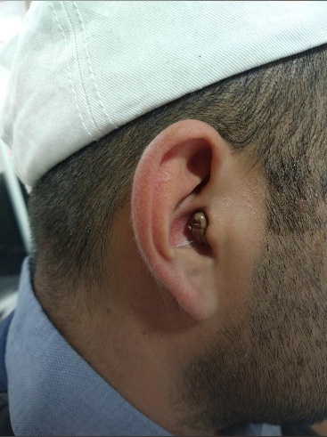 Intraauricular ITE CIC colocado